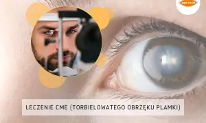 Leczenie CME (torbielowatego obrzęku plamki) – krople pomagające przywrócić ostrość widzenia. Badanie oka przez lekarza.