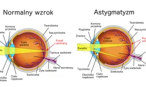 Porównanie budowy oka: normalny wzrok skupia światło na siatkówce, astygmatyzm odwrotny powoduje zniekształcenie obrazu.