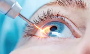Zabieg laserem na wąski kąt przesączania. Jasny promień lasera działa na niebieskie oko, poprawiając widzenie.