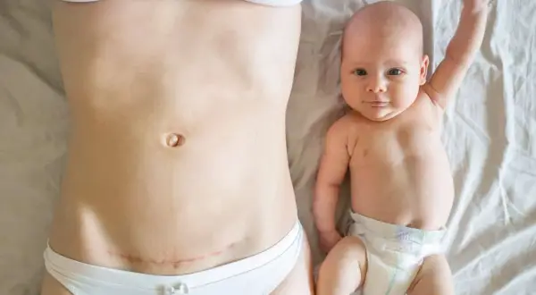 Po cesarskim cięciu, które może być związane z wadą wzroku a porodem, mama i dziecko leżą obok siebie.