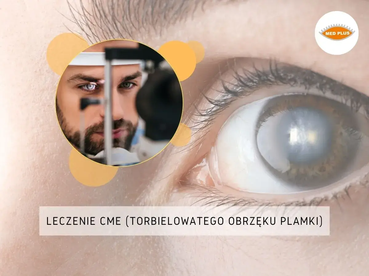 Leczenie CME (torbielowatego obrzęku plamki) – krople pomagające przywrócić ostrość widzenia. Badanie oka przez lekarza.