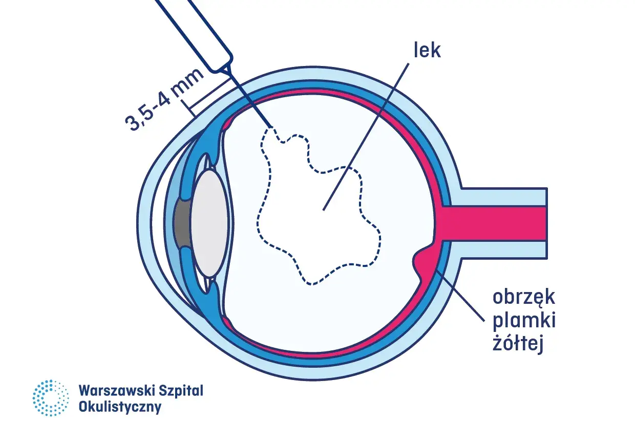 Leczenie wylewu podsiatkówkowego: iniekcja leku do oka, by zwalczyć obrzęk plamki żółtej.