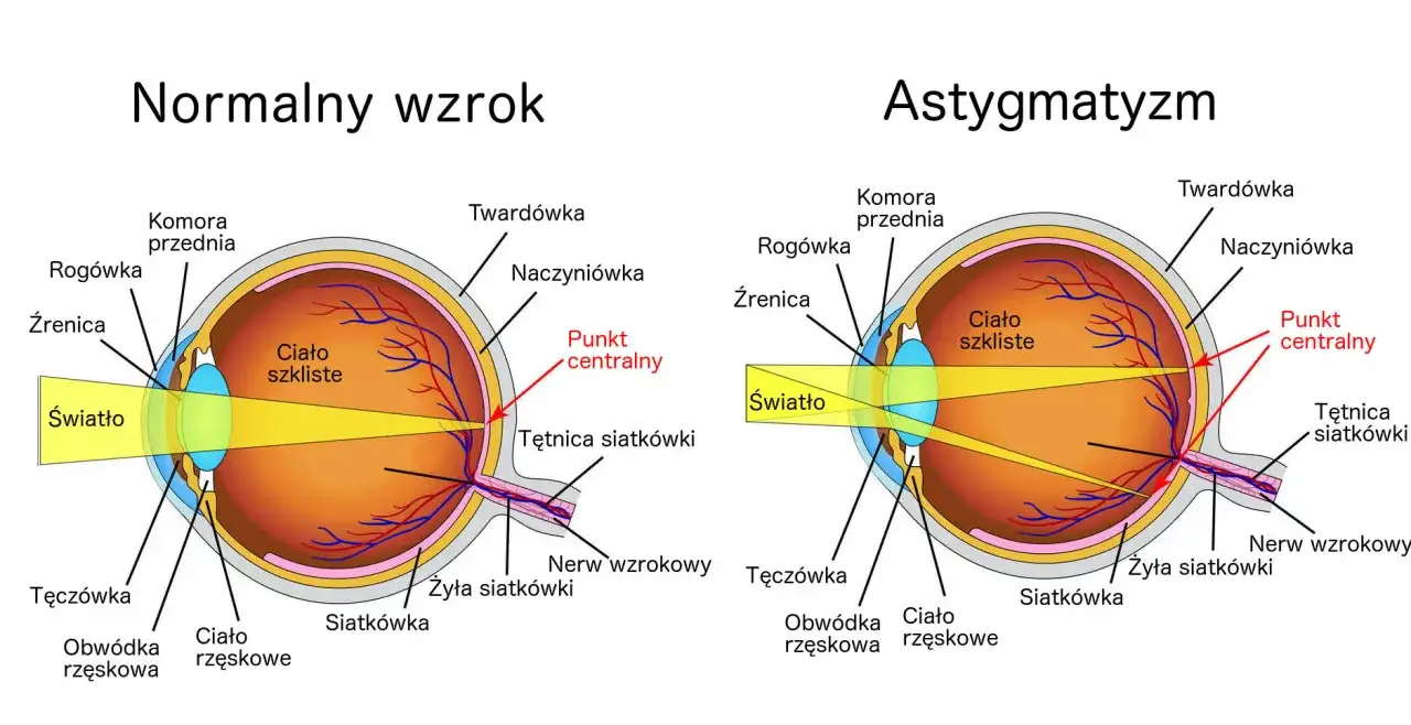 Porównanie budowy oka: normalny wzrok skupia światło na siatkówce, astygmatyzm odwrotny powoduje zniekształcenie obrazu.