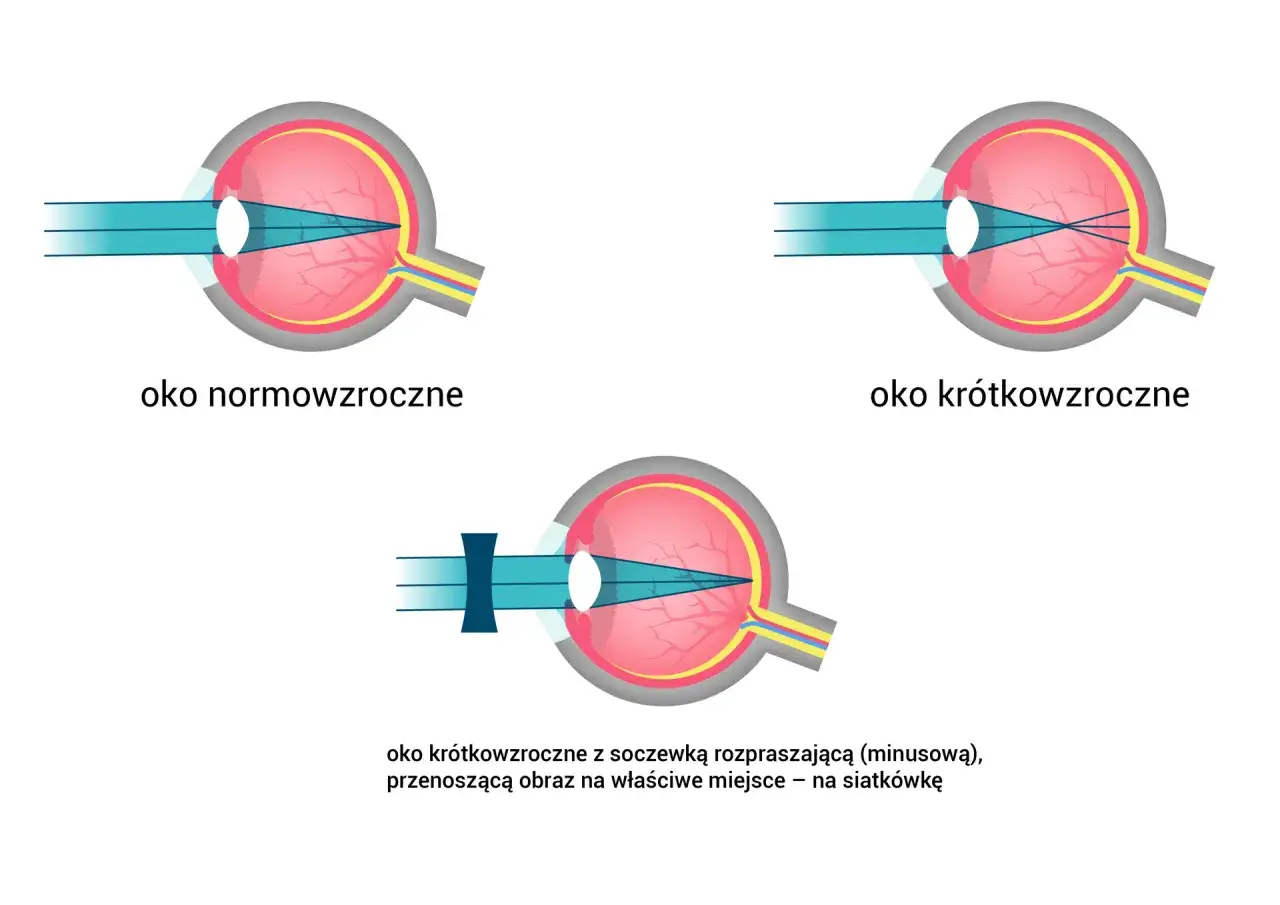 Ilustracja pokazuje budowę oka: normowzrocznego, krótkowzrocznego i krótkowzrocznego z soczewką korygującą.