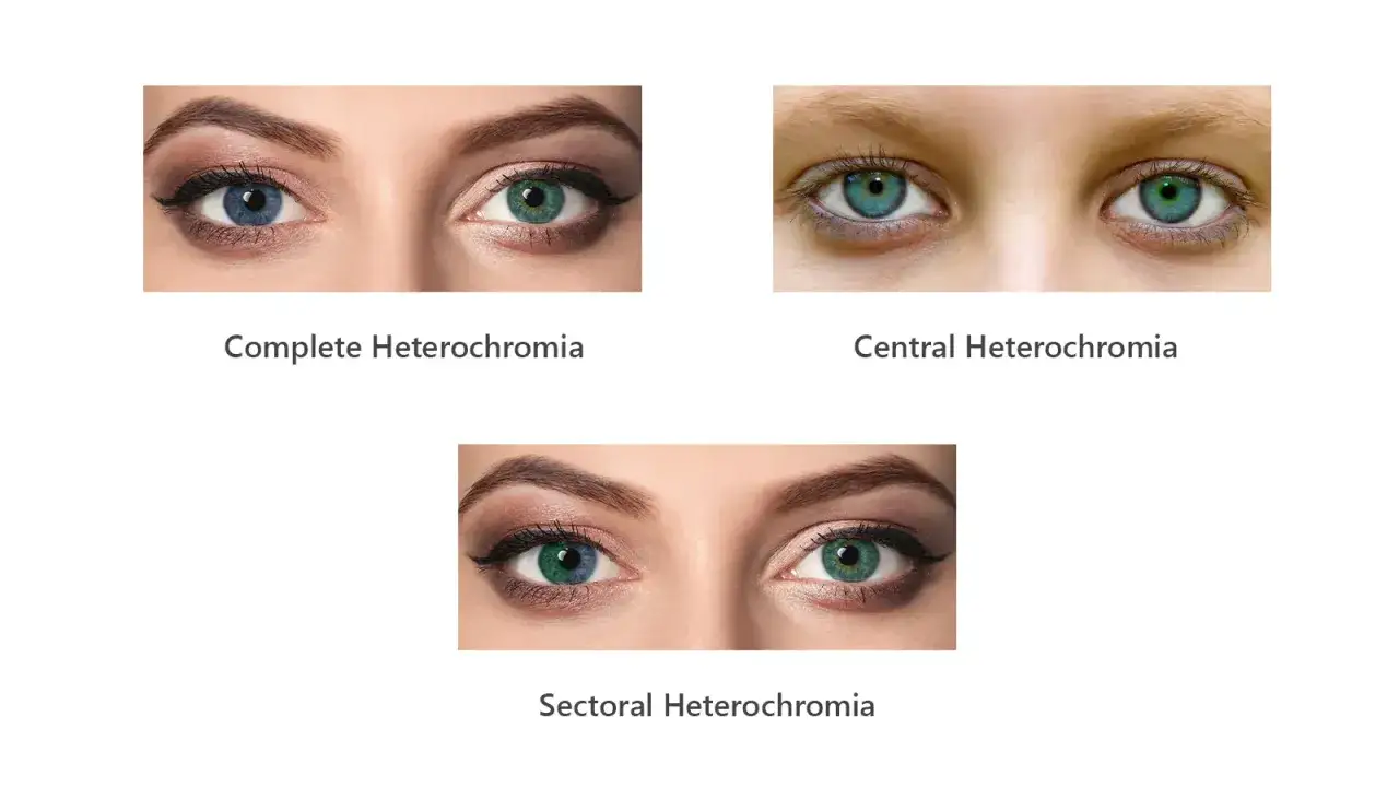 Trzy przykłady heterochromii: pełna, centralna i sektorowa. Centralna heterochromia oczu to ciekawa cecha.