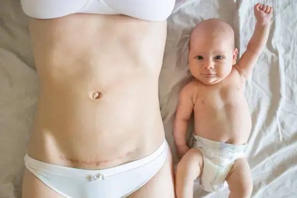 Po cesarskim cięciu, które może być związane z wadą wzroku a porodem, mama i dziecko leżą obok siebie.