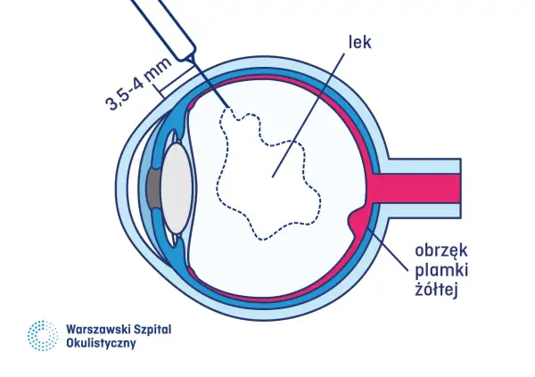 Leczenie wylewu podsiatkówkowego: iniekcja leku do oka, by zwalczyć obrzęk plamki żółtej.