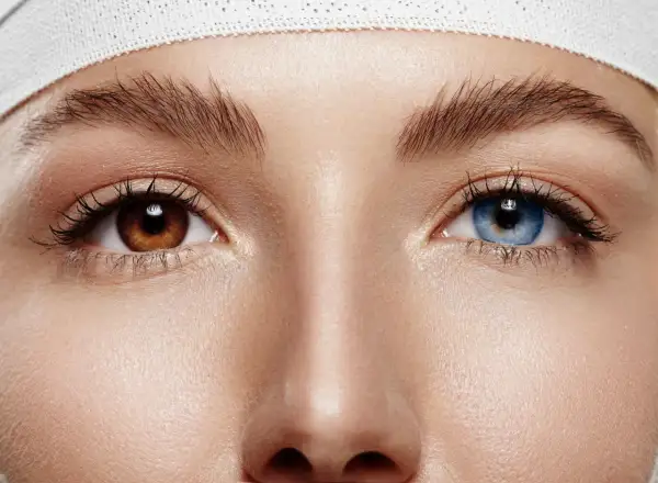 Oczy z różnymi kolorami tęczówek – jedno brązowe, drugie niebieskie. To piękny przykład heterochromii częściowej.